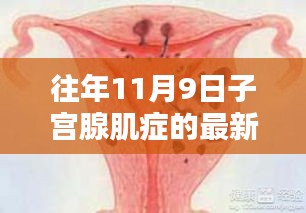 探秘特色诊所，揭秘子宫腺肌症最新疗法圣地，11月9日深度解析