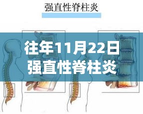 历年11月22日强直性脊柱炎最新治疗方案的进展回顾与评估