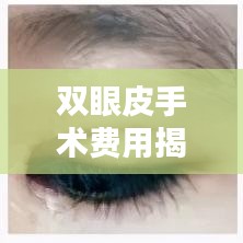 双眼皮手术费用揭秘，缝双眼皮的价格及其相关因素全解析